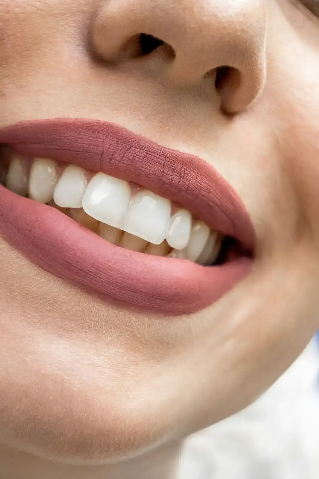 In-chair teeth whitening at Enrich Aesthetics in Wangi Wangi, Lake Macquarie